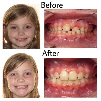 Julia Before and After