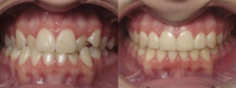 Karis Before and After 1