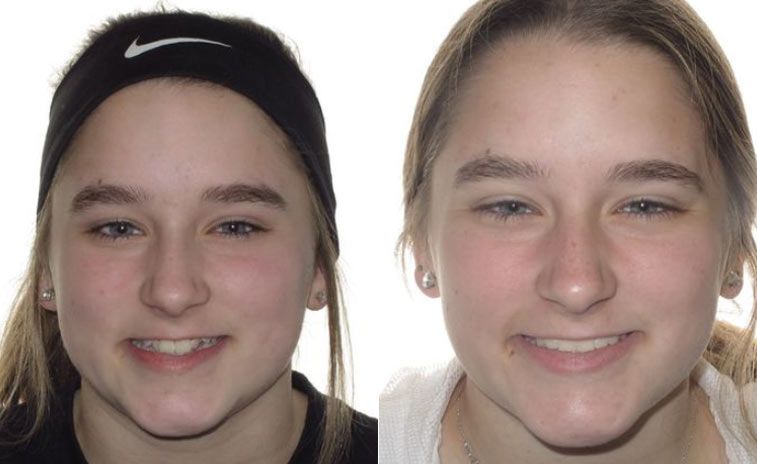 Karis Before and After 2