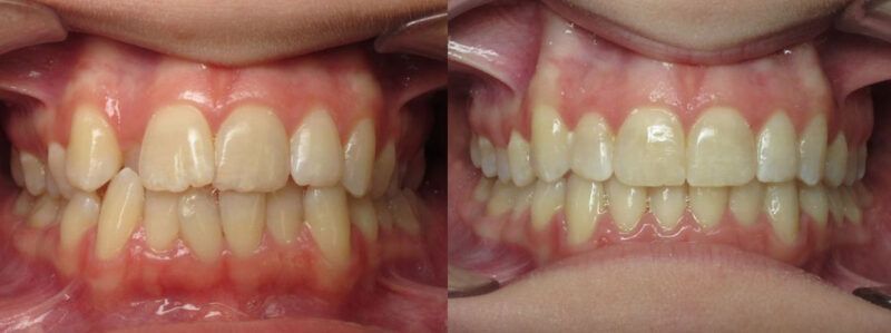 Louise Before and After 1