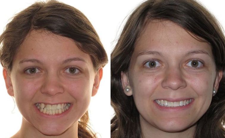Louise Before and After 2