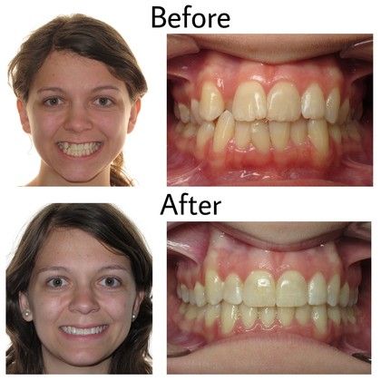 Louise Before and After