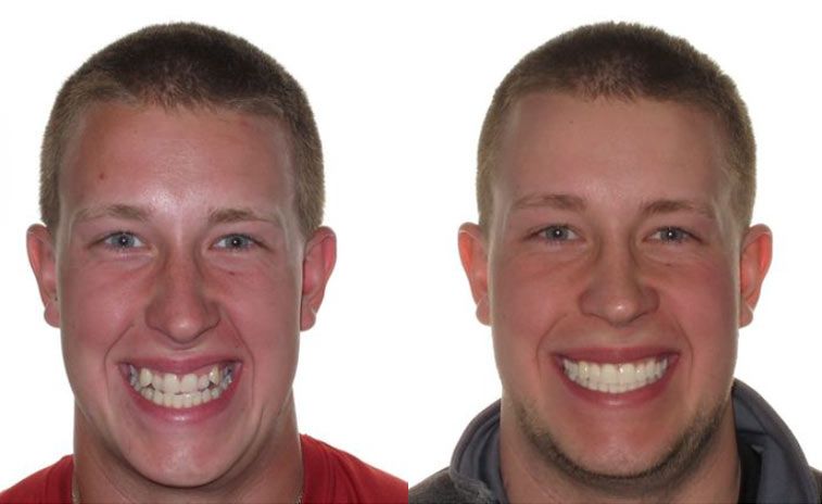 Matt Before and After 1