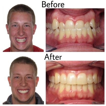 Matt Before and After