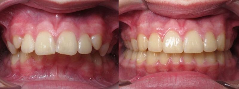 Parker Before and After 1