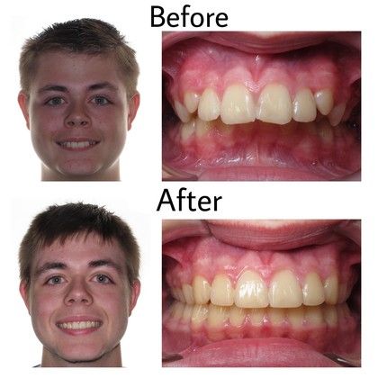 Parker Before and After