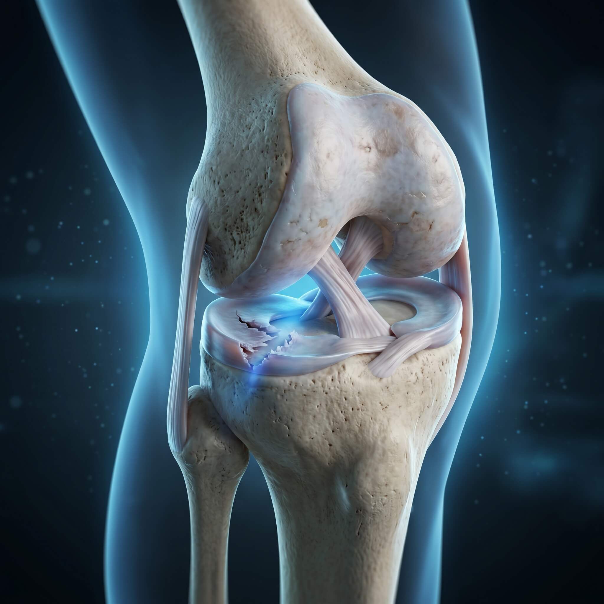 3D medical visualization of a meniscus tears