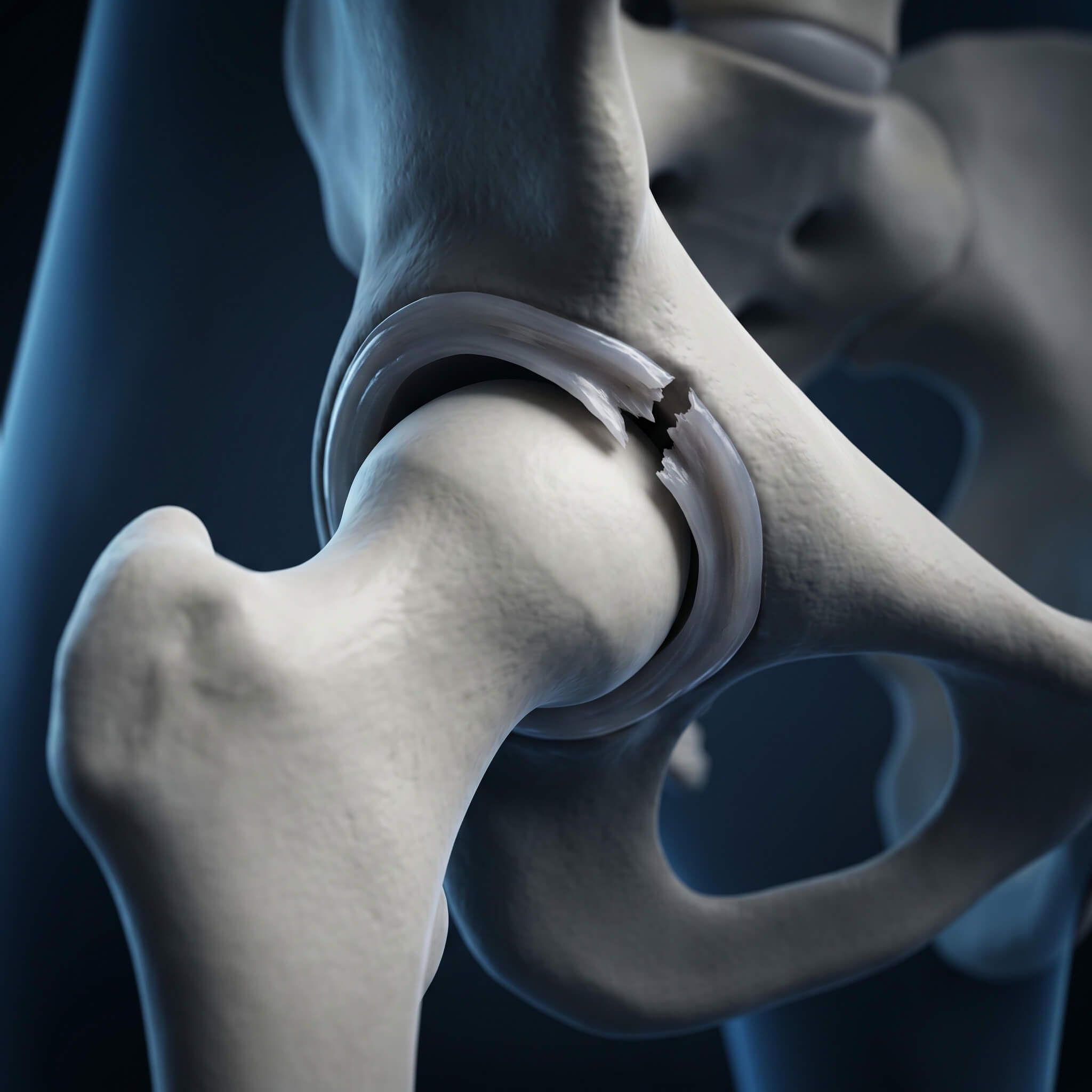 High-resolution 3D rendering of hip labral tears