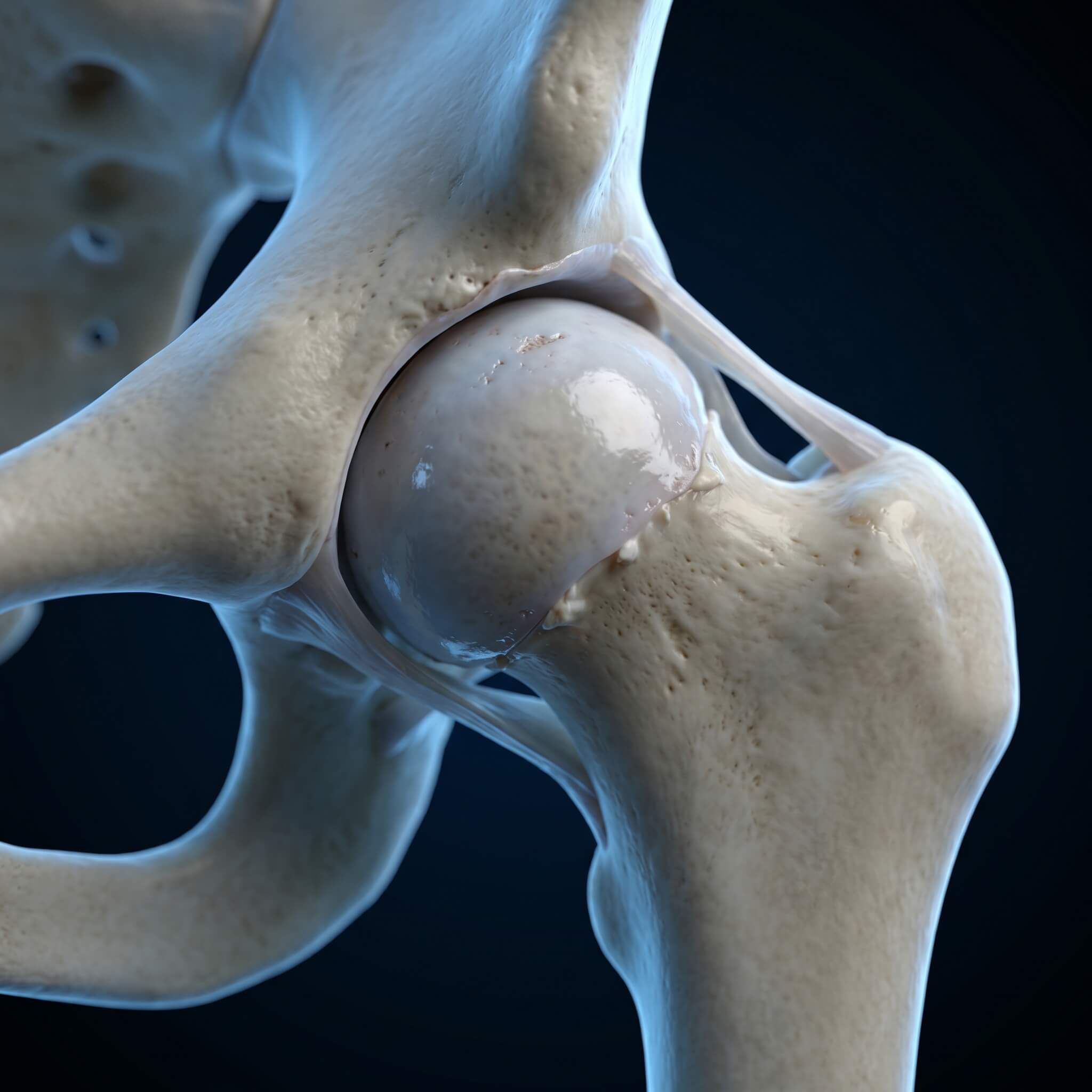 Ultra-detailed 3D medical rendering of a hip arthritis
