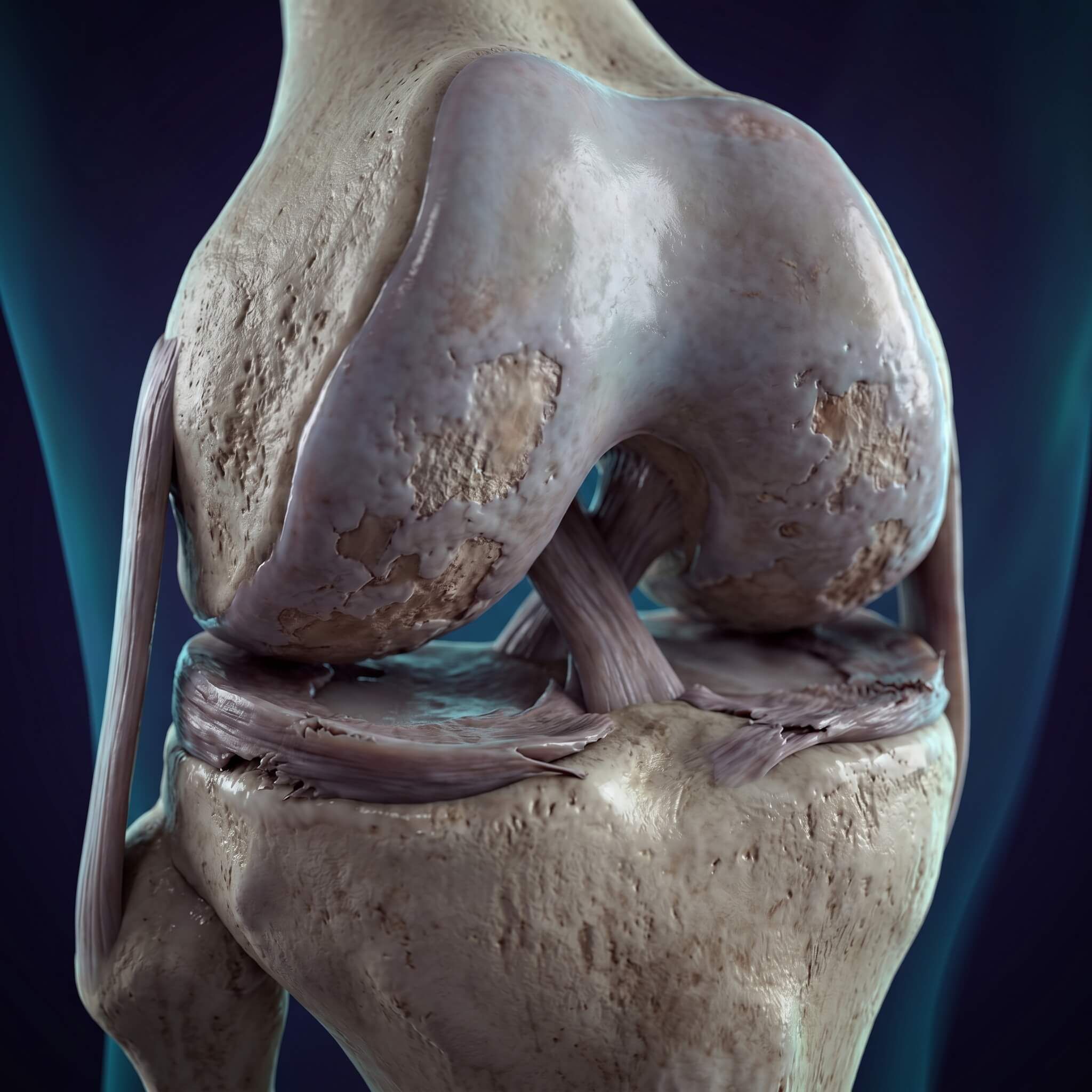 Ultra-detailed 3D rendering of a knee arthritis
