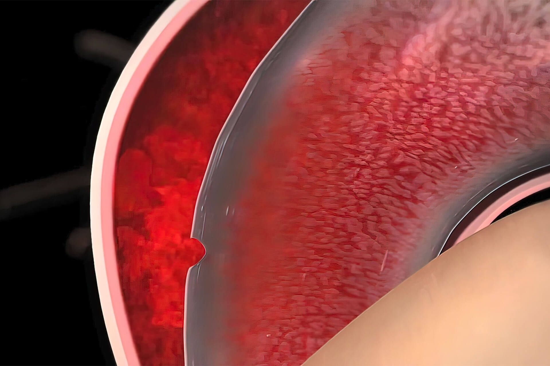 Medical illustration showing a narrowed or damaged blood vessel, possibly an aortic aneurysm or artery blockage