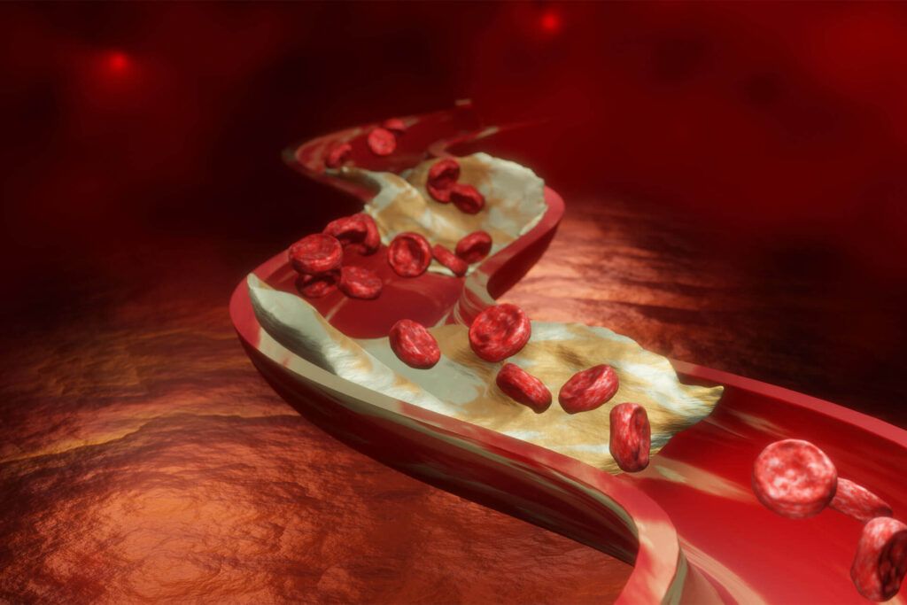 Medical illustration showing plaque buildup narrowing an artery and restricting blood flow