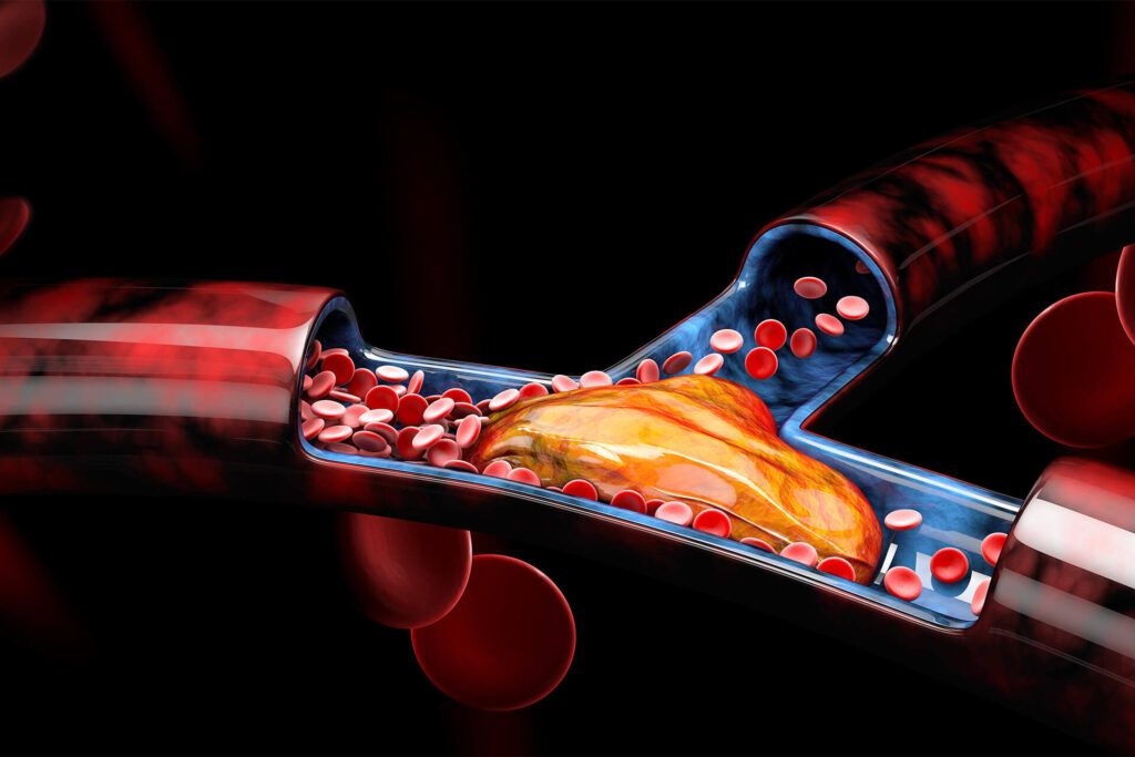 Medical illustration of plaque buildup blocking blood flow inside an artery or blood vessel