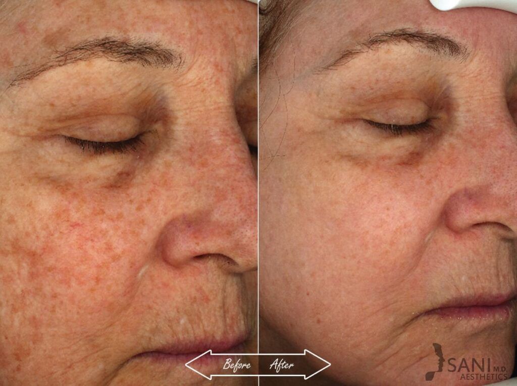 Chemical Peels Before After 10