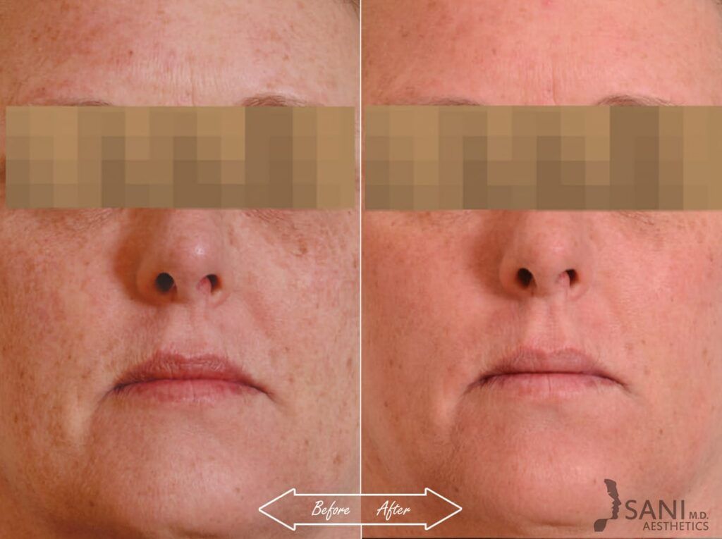 Chemical Peels Before After 11