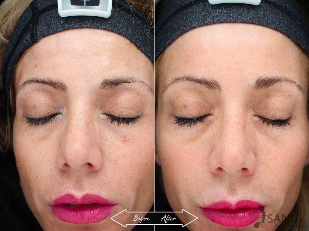 Chemical Peels Before After 12