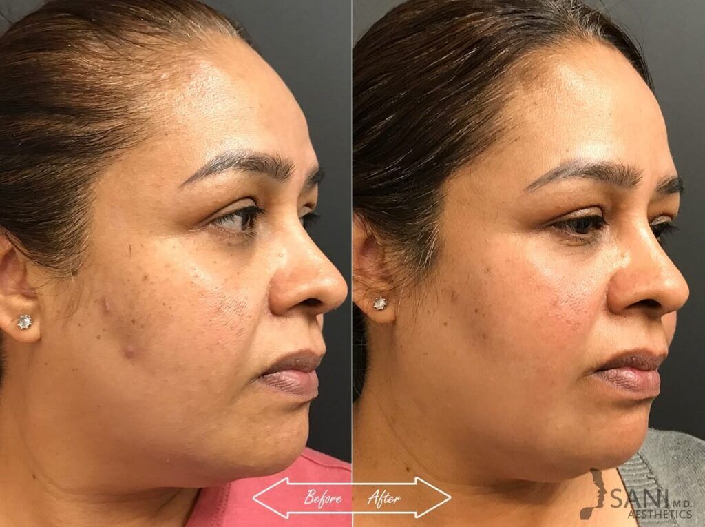 Chemical Peels Before After 13