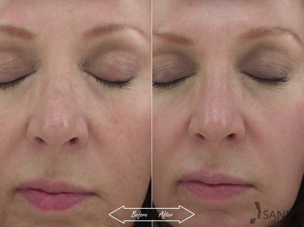 Chemical Peels Before After 2