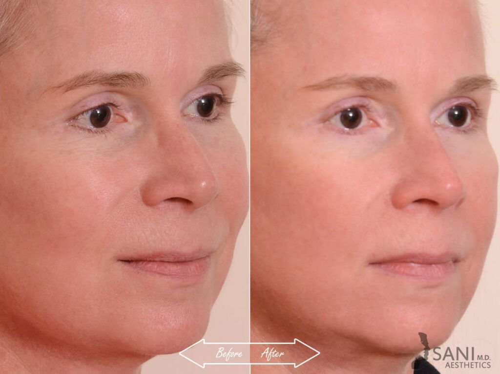 Chemical Peels Before After 3