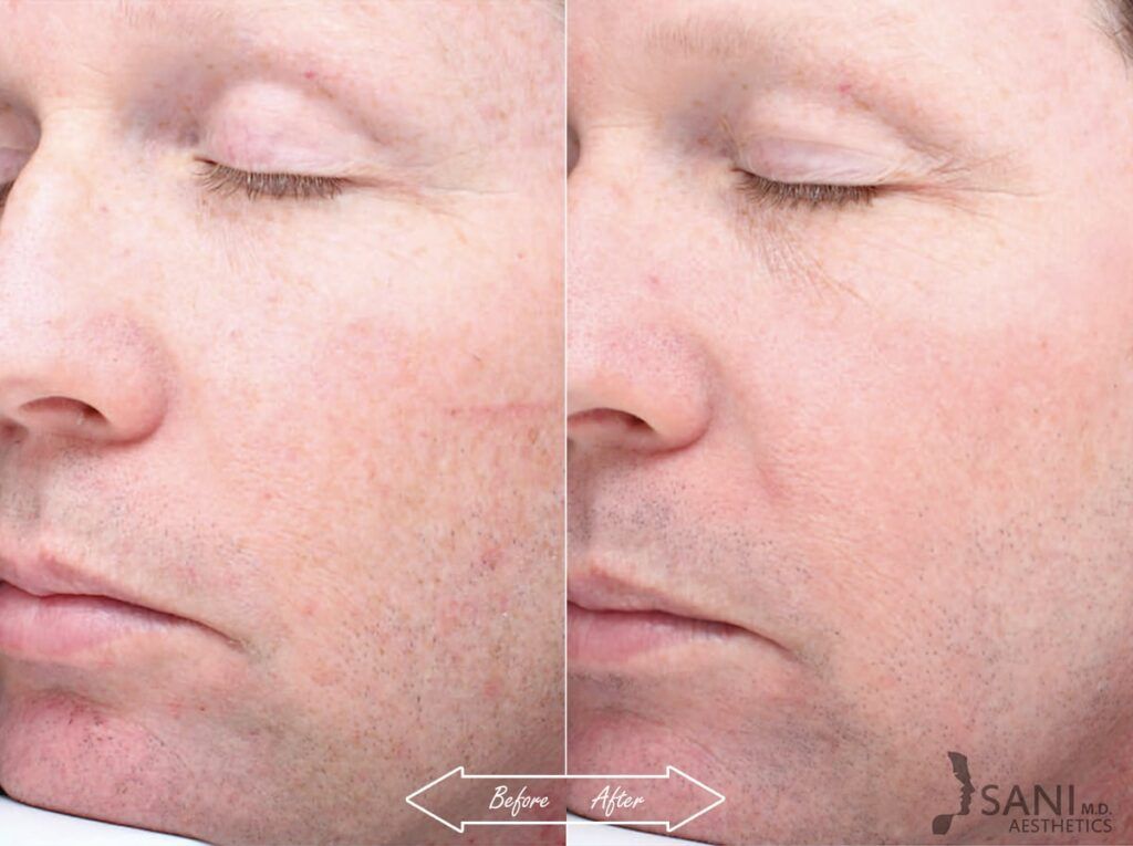 Chemical Peels Before After 4