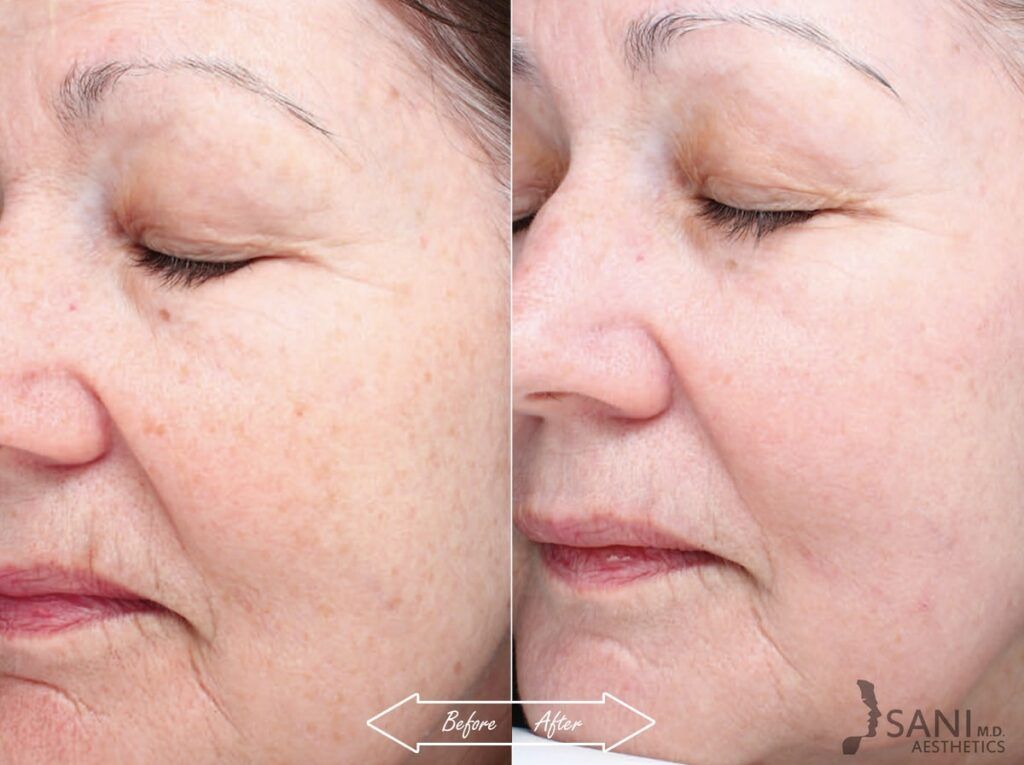 Chemical Peels Before After 5