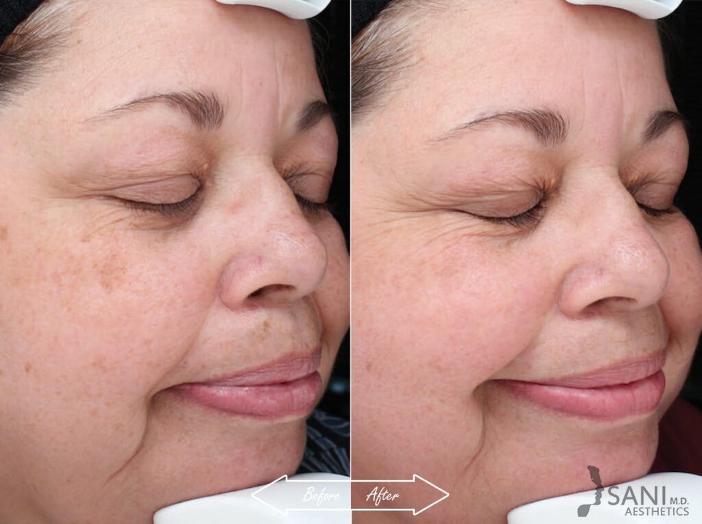 Chemical Peels Before After 6