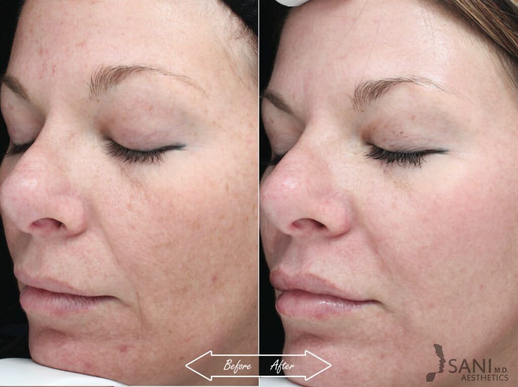 Chemical Peels Before After 7