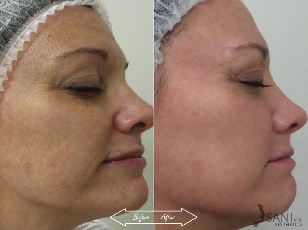 Chemical Peels Before After 8
