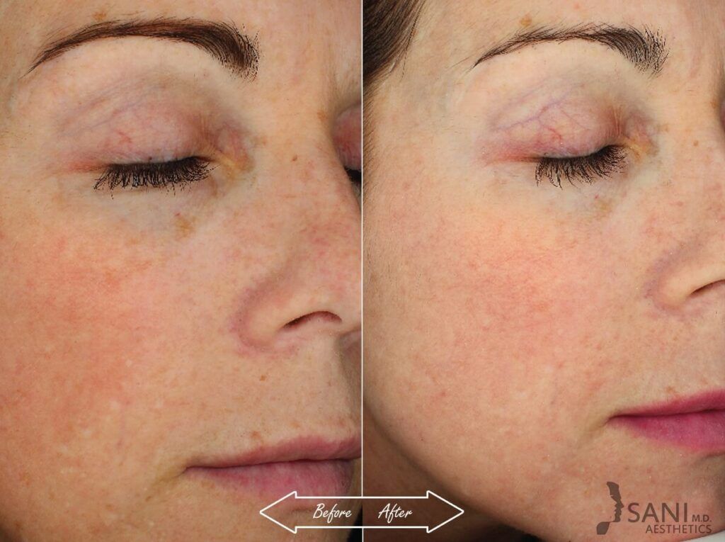 Chemical Peels Before After 9
