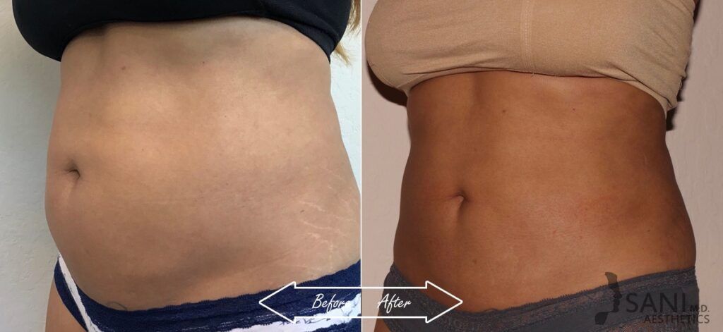 CoolSculpting Before After 10