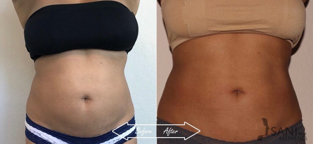 CoolSculpting Before After 11