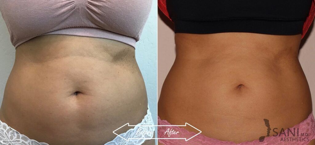CoolSculpting Before After 12