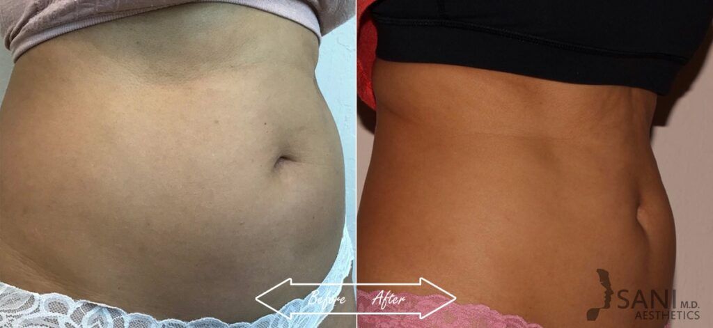 CoolSculpting Before After 13