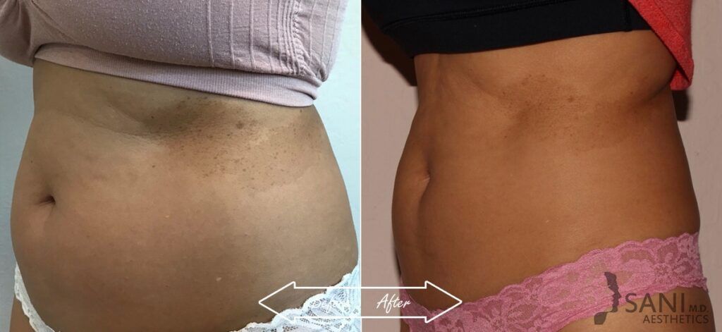 CoolSculpting Before After 14