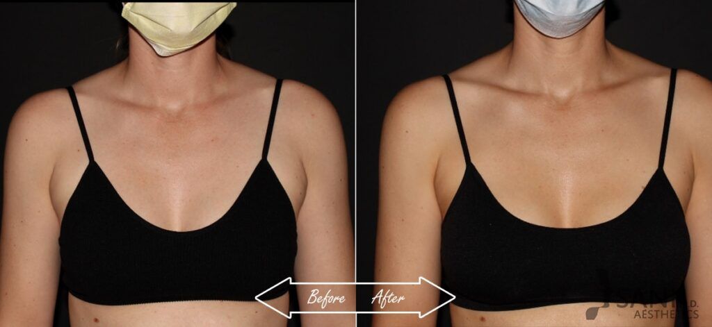 CoolSculpting Before After 15