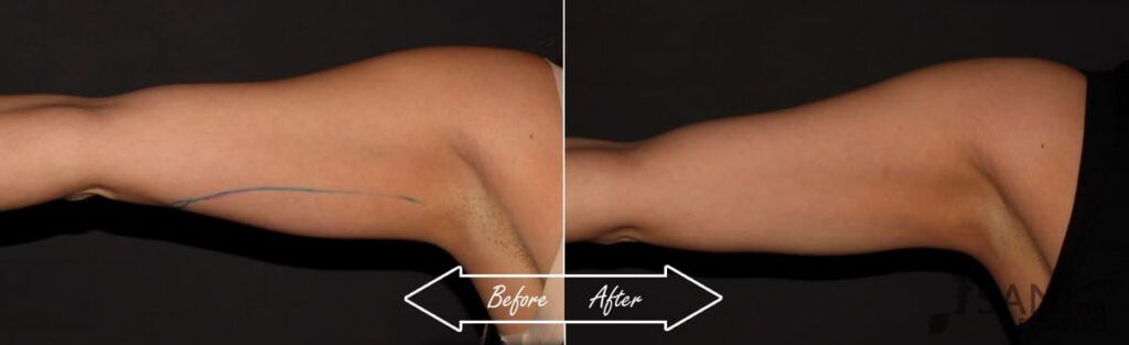 CoolSculpting Before After 16
