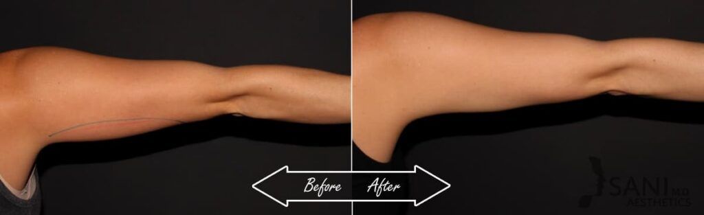 CoolSculpting Before After 17