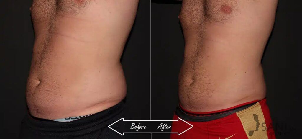 CoolSculpting Before After 2