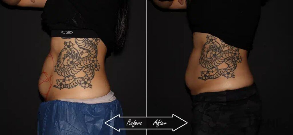 CoolSculpting Before After 3