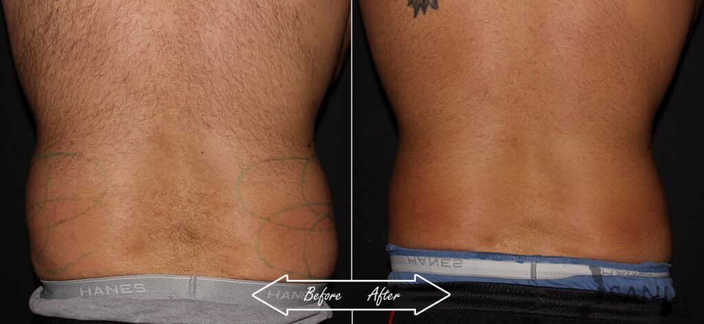 CoolSculpting Before After 4