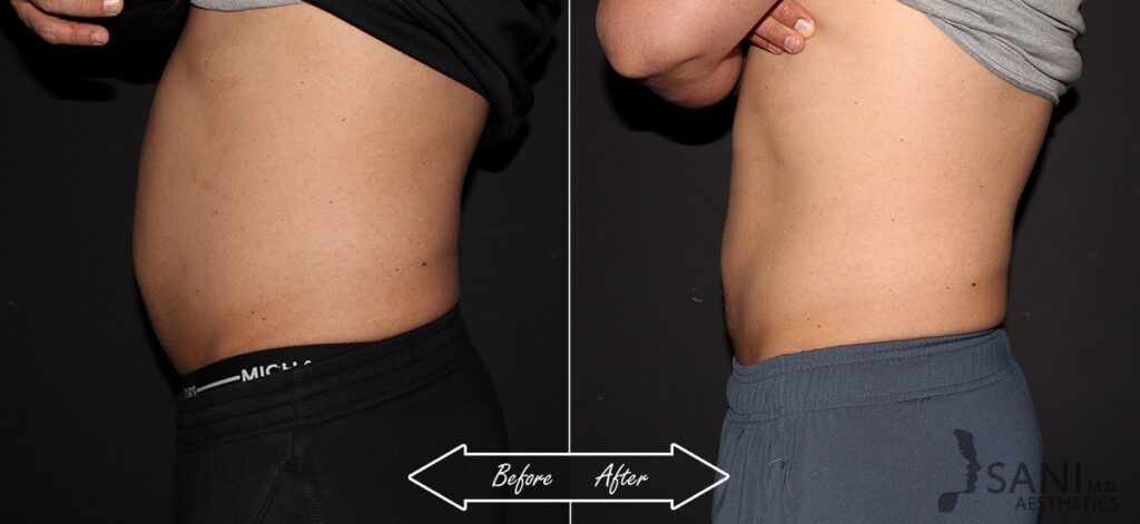 CoolSculpting Before After 5