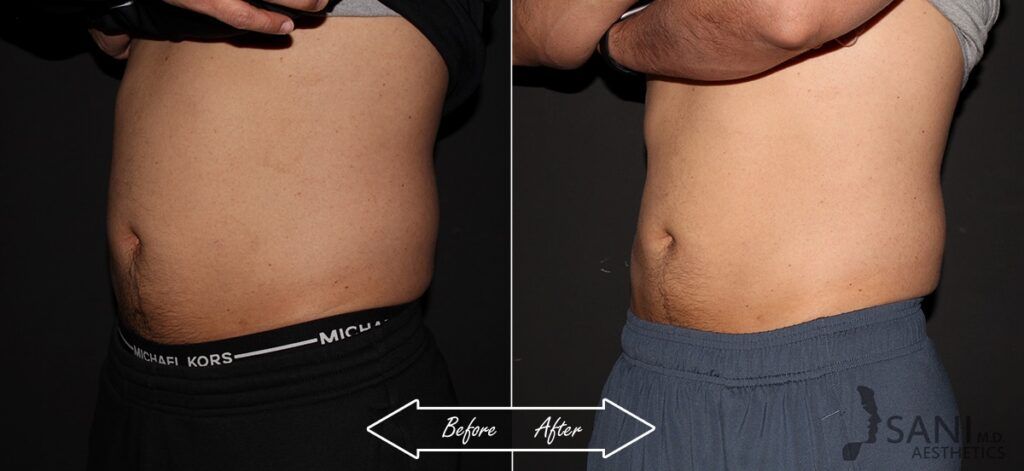 CoolSculpting Before After 6