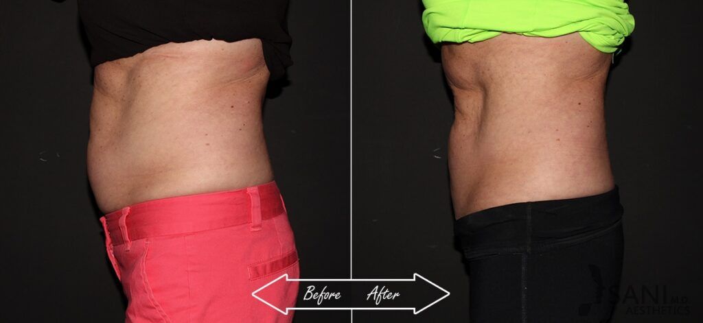 CoolSculpting Before After 7