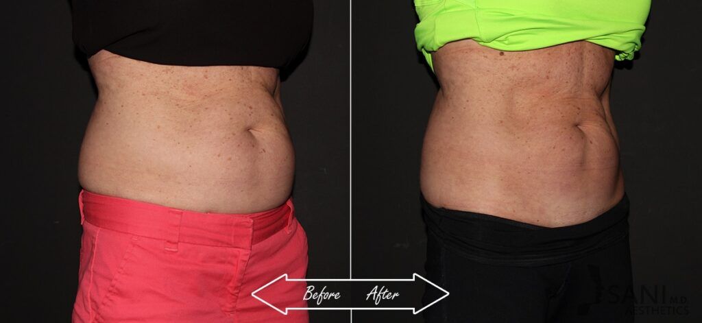 CoolSculpting Before After 8