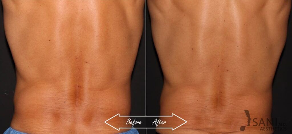CoolSculpting Before After 9