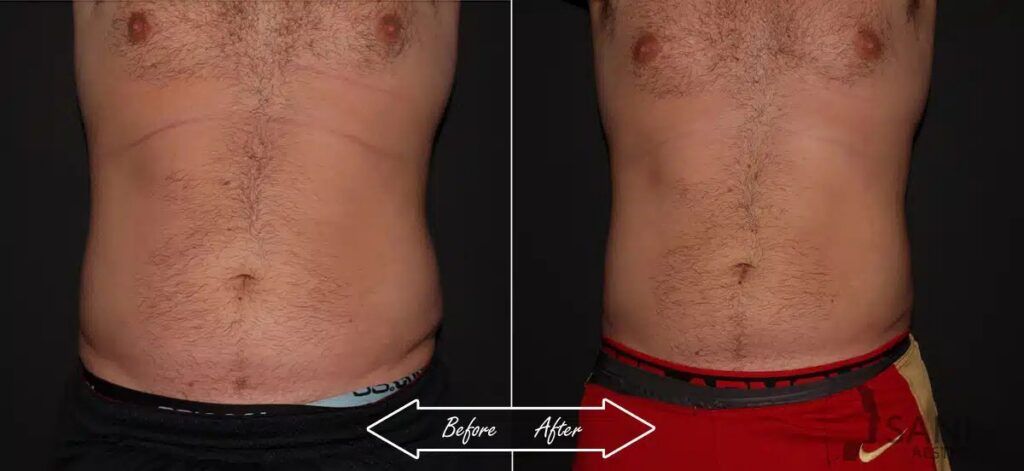 CoolSculpting Before After First