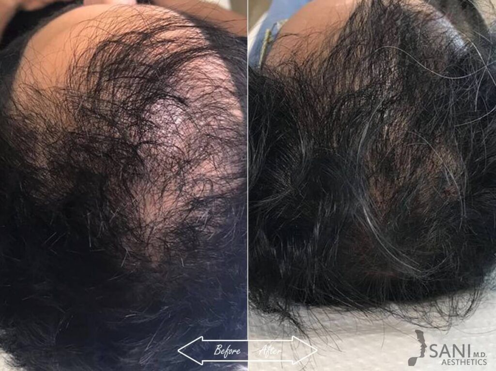 PRP Hair Restoration Before After 10