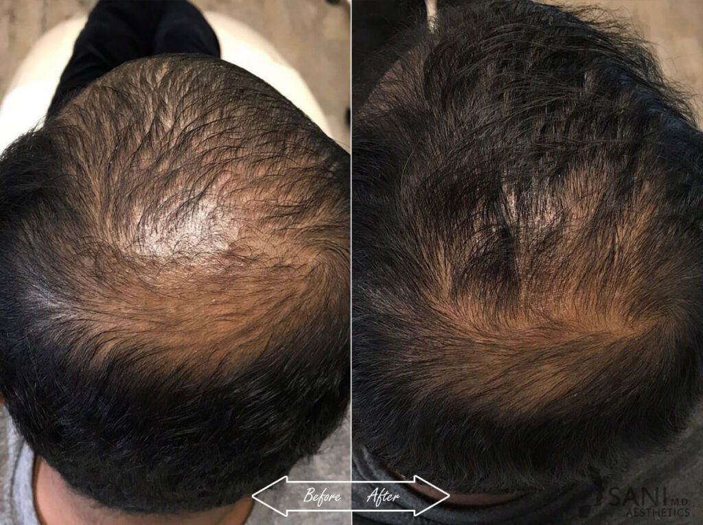 PRP Hair Restoration Before After 11
