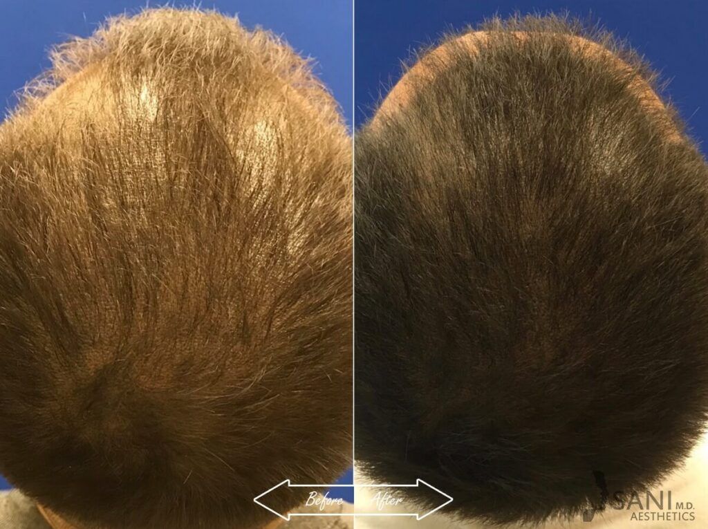 PRP Hair Restoration Before After 12