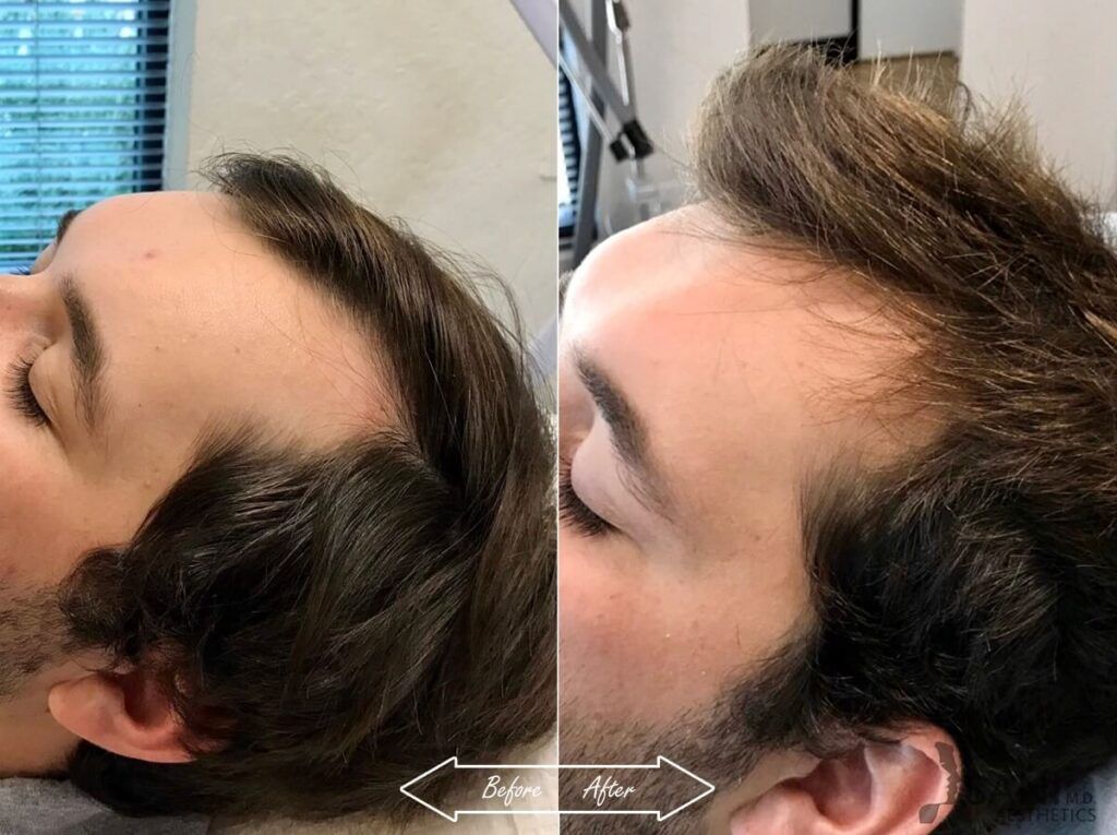 PRP Hair Restoration Before After 13